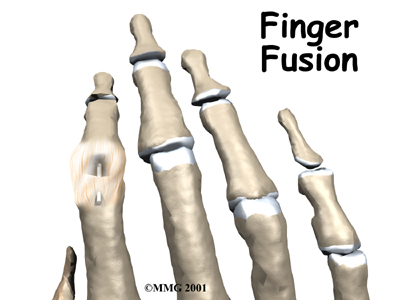 Finger Fusion Surgery - Granville Physiotherapy's Guide