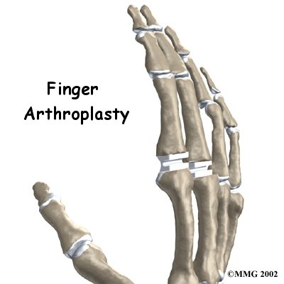 Artificial Joint Replacement of the Finger - Granville Physiotherapy's Guide