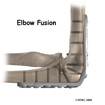 Elbow Fusion